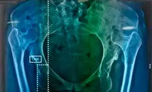 Traumatólogo en Saltillo de cadera | Dr. Eduardo Macías